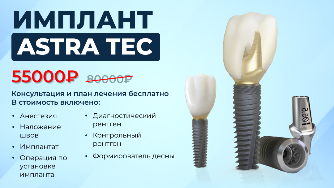 Импланты Astra Tech - золотой стандарт в дентальной имплантации