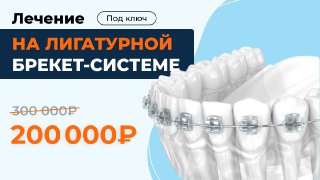 Лигатурные брекеты под ключ